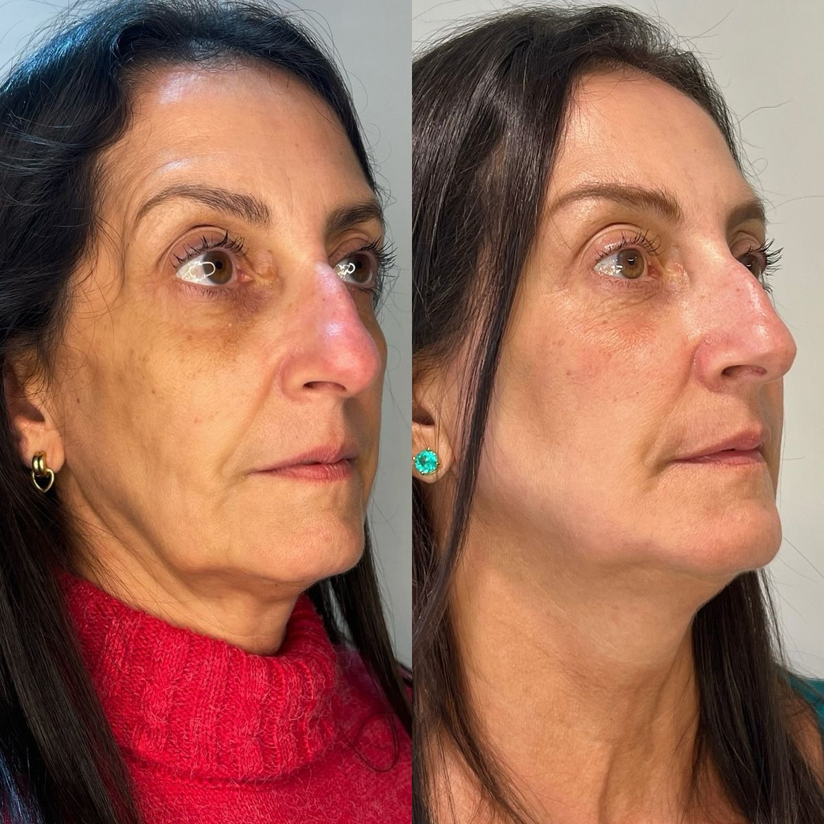 Non-surgical face and neck contours
