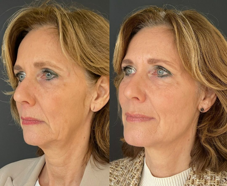 Before and after 1